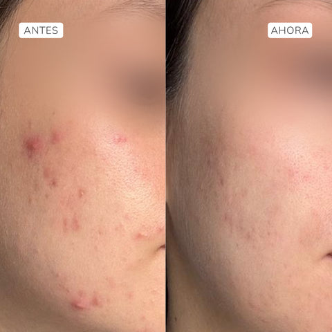 Serum exfoliante ácido glicólico 4% + láctico 2.5%